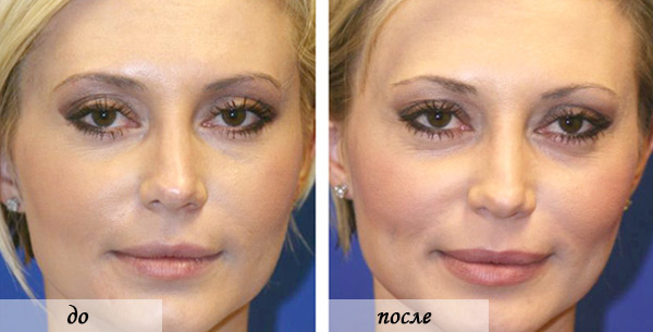 лазерная шлифовка лица фото до и после